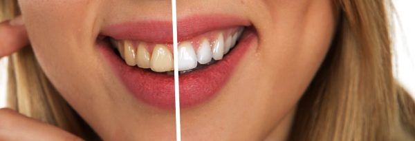 teeth-whitening-dentist-greenfields